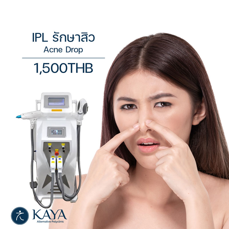 IPL รักษาสิว