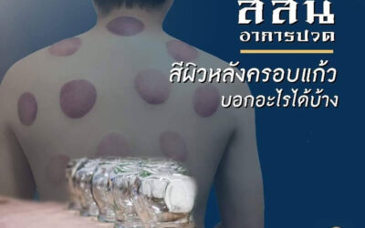 การครอบแก้ว