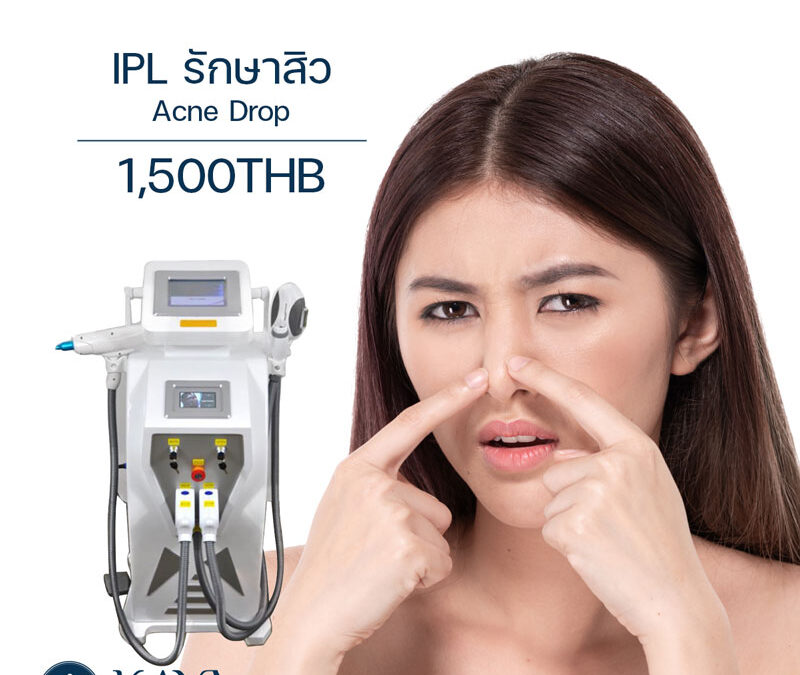 IPL รักษาสิว